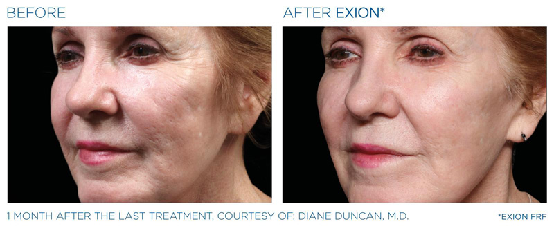 EXION2