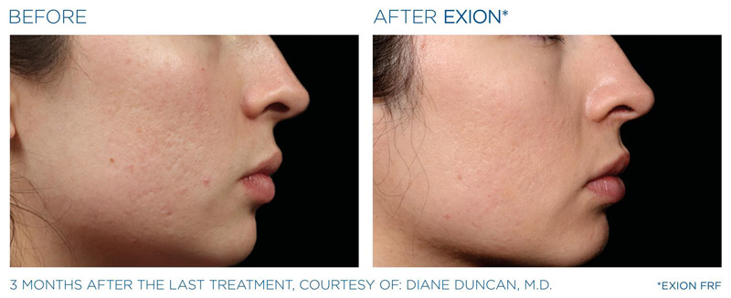EXION RF Fractionnée par Microneedling