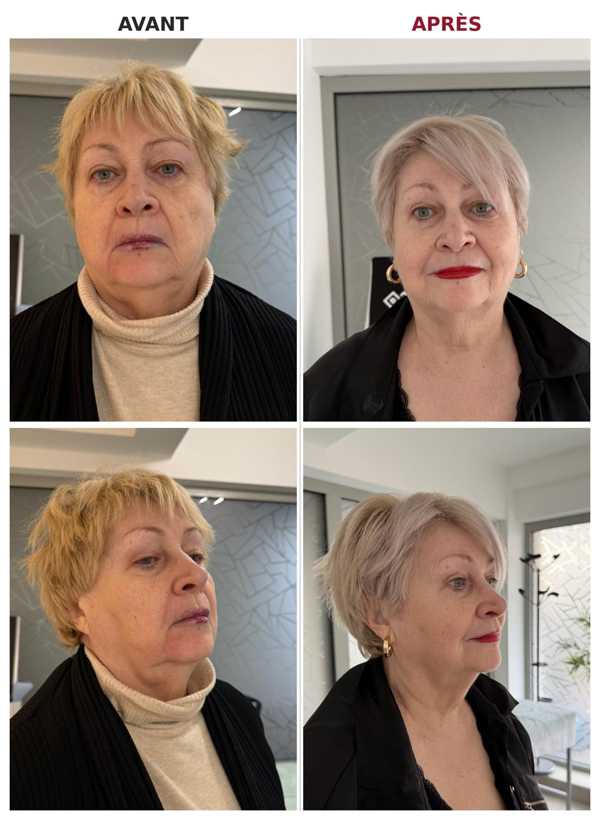 Avant-Apres-1-Microneedling RF avec EXION Avant-Apres-1-Microneedling RF avec EXION