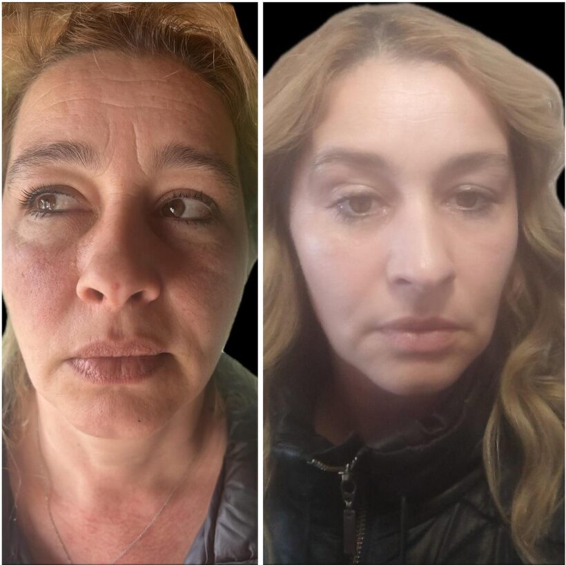 Avant-Apres-2-La procédure Full Face Avant-Apres-4-Augmentation des lèvres