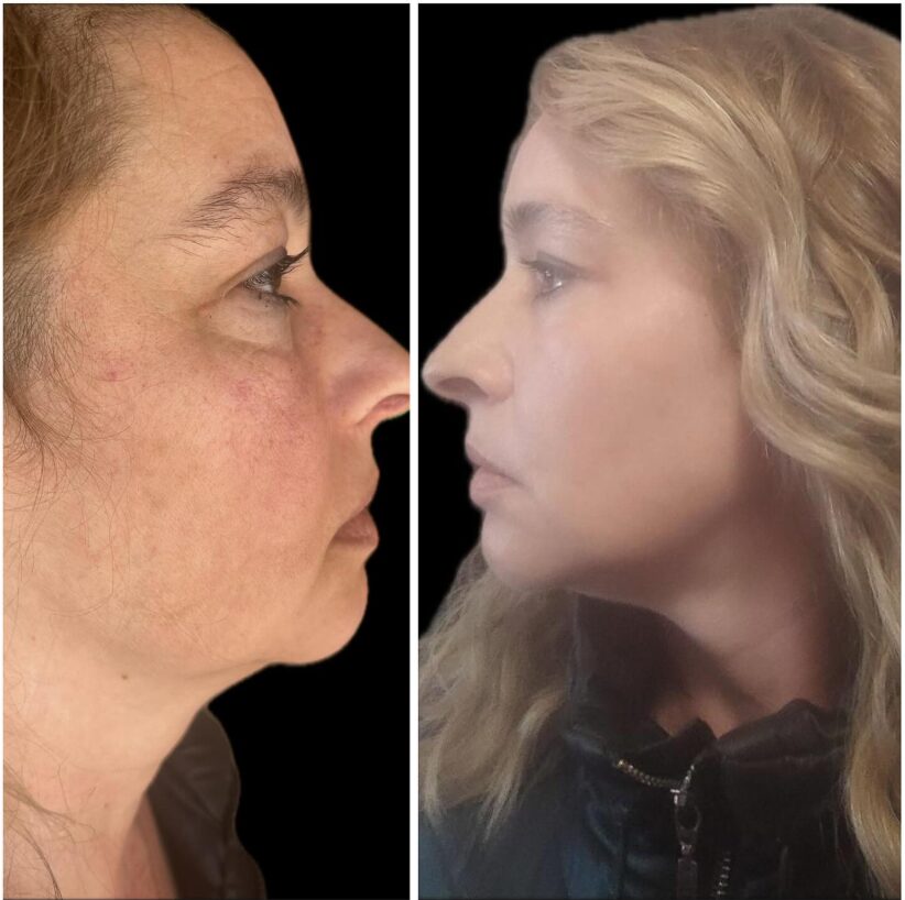 Avant-Apres-3-Full Face sans Botox ni chirurgi -La procédure Full Face