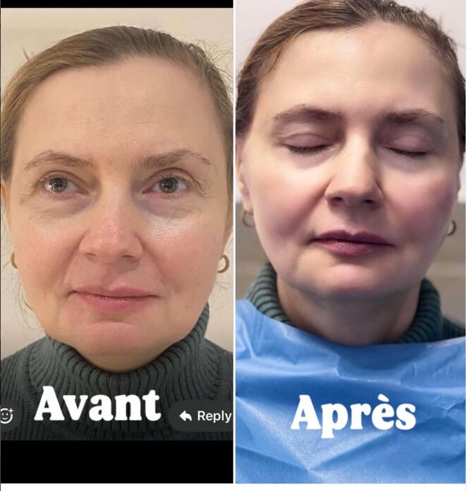 Avant-Apres-5-lifting par fils Avant-Apres - Lifting par fils